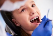 Dove mettere l’apparecchio ai denti per bambini a Napoli: guida per i genitori apparecchio denti bambini napoli